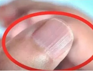 91看片免费版廠家分析手指甲有豎紋的根本原因 91看片免费版廠家分析手指甲有豎紋的根本原因